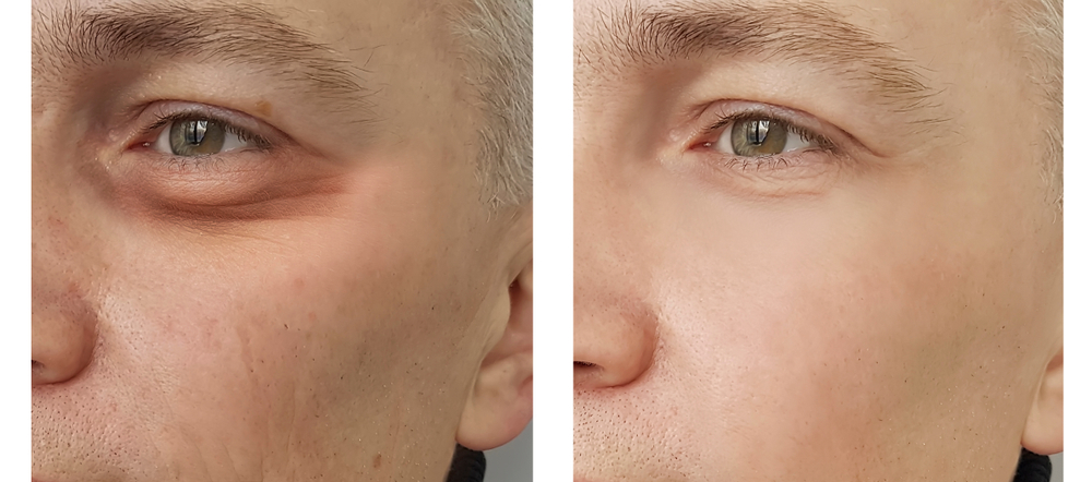 man,eye swollen before and after procedures