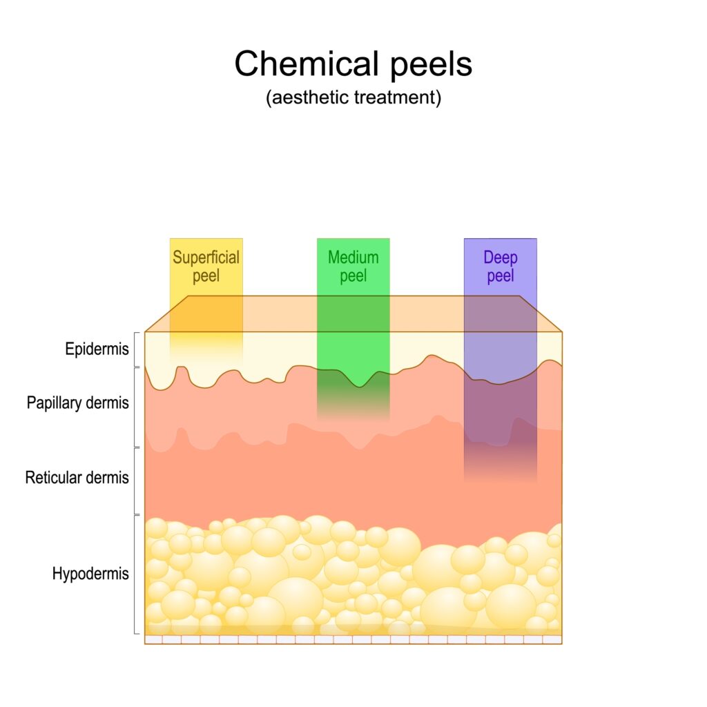 Beauty aesthetic treatment. Chemical peels.