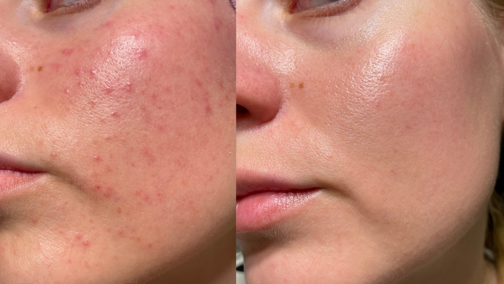 Close-up comparison of female cheek skin before and after care