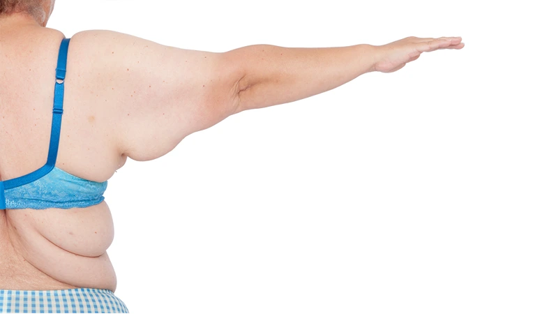 Middle aged woman with sagging excess arm skin after extreme weight loss. Before brachioplasty, panniculectomy, abdominoplasty and mummy makeover. Back view full right arm.