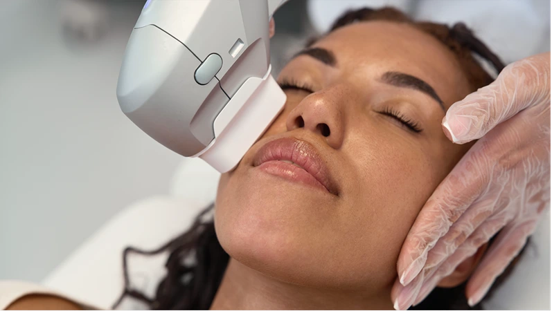 Facial rejuvenation using SMAS lifting is performed on the cheek of an African woman. High intensity focused ultrasound supports collagen stimulation without injections